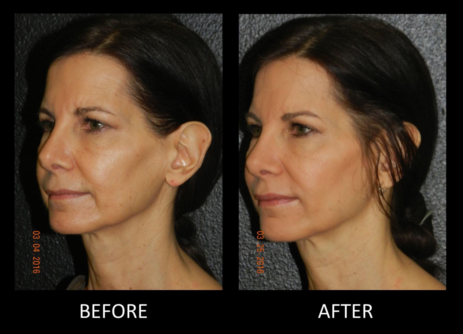 Facial Fillers in Montrose, Houston, TX